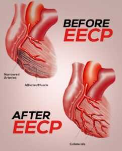 eecp treatment for heart failure